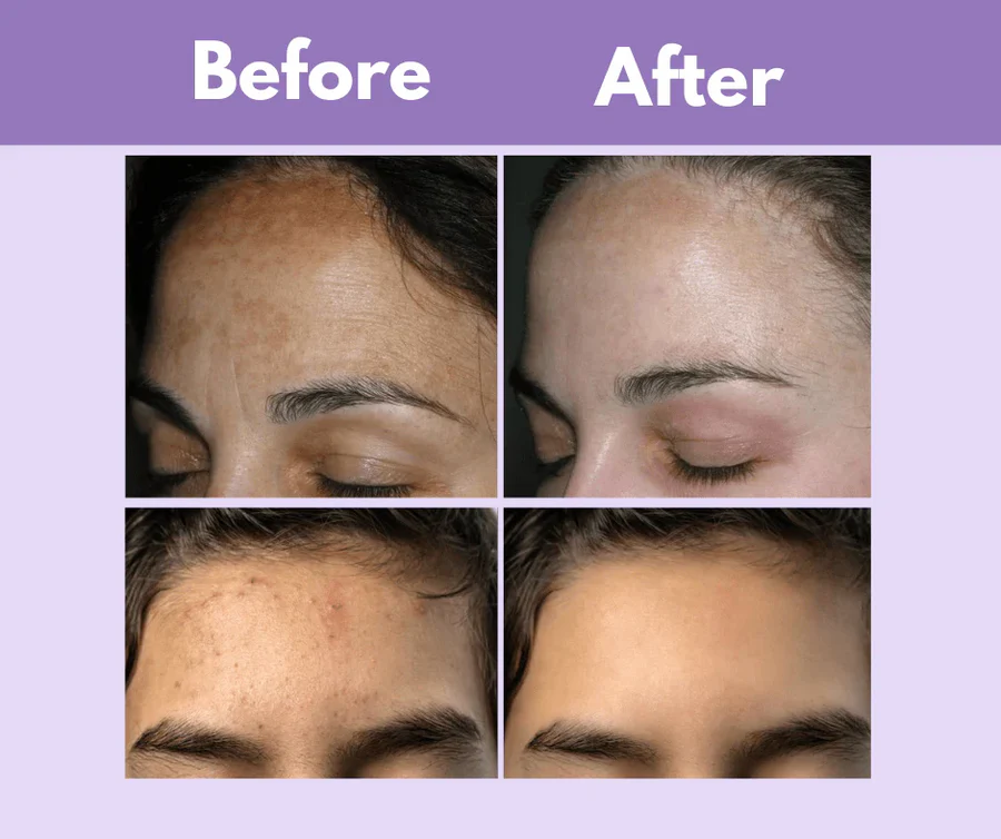 LED Face Mask Therapy  Pakistan | Wrinkle, Acne and Pigmentation Treatment at home